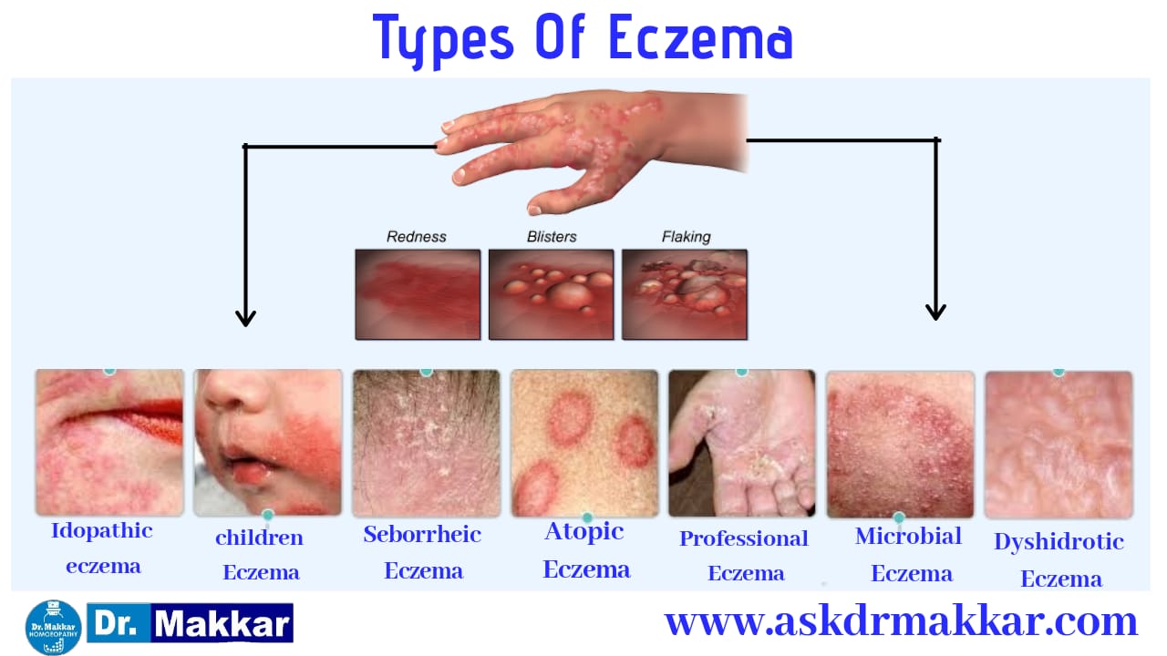 Types of eczema